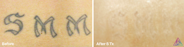 Before and after tattoo removal
